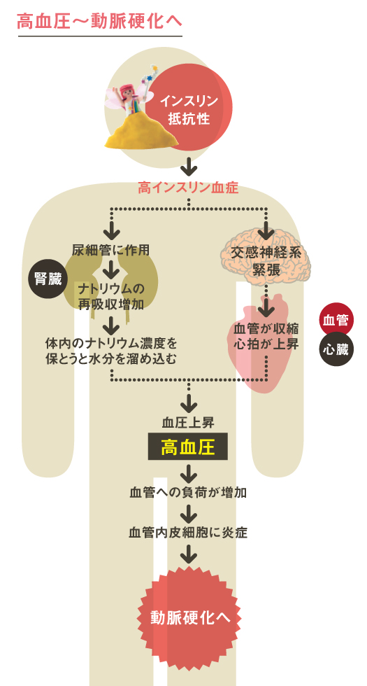 絵で見て分かる生活習慣病⑤ 高インスリン血症から生活習慣病へ